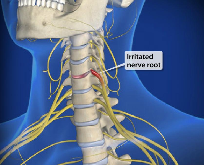 Arm Pain Image