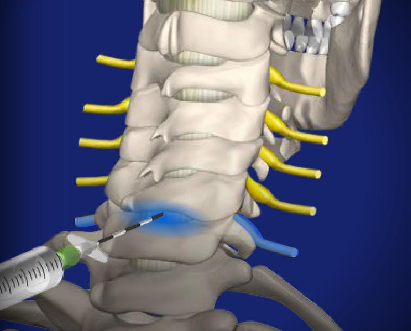 Cervical Epidural Steroid Injection Image