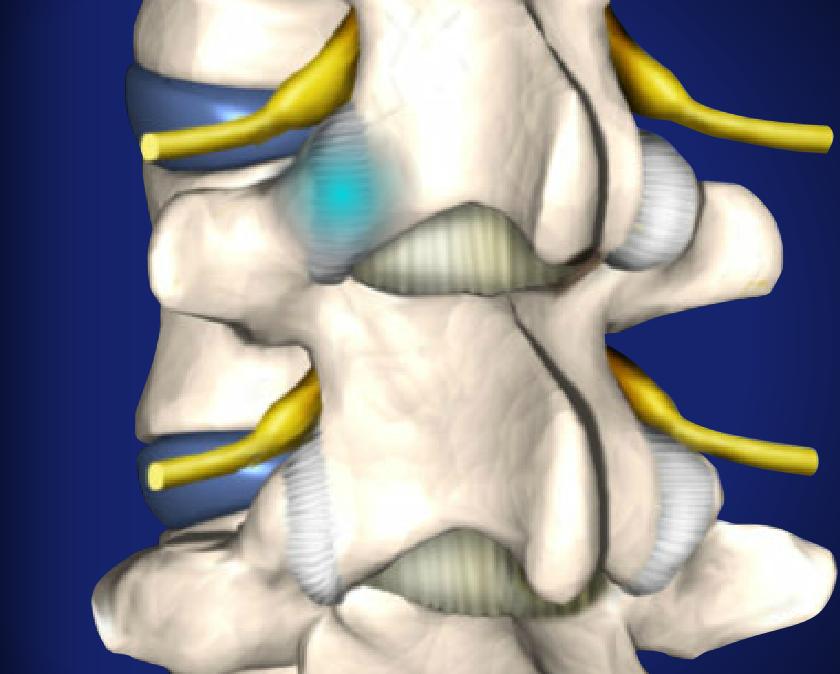 Facet Joint Injections Image
