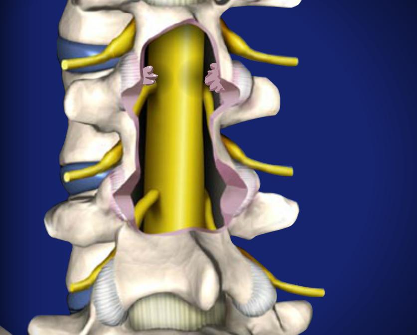 Failed Back Surgery Image