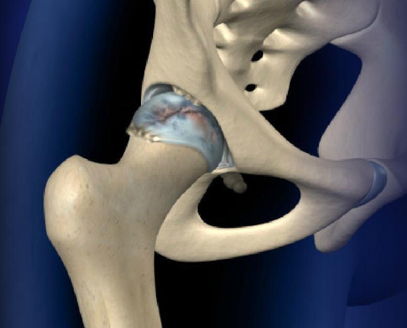 Fluoroscopically-Guided Hip Injection Image