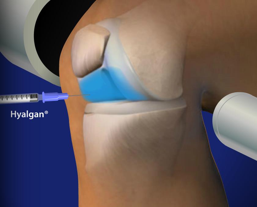 Fluoroscopic Guided Hyalgan® Injection for Knee Pain Image