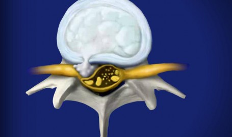 herniateddisc