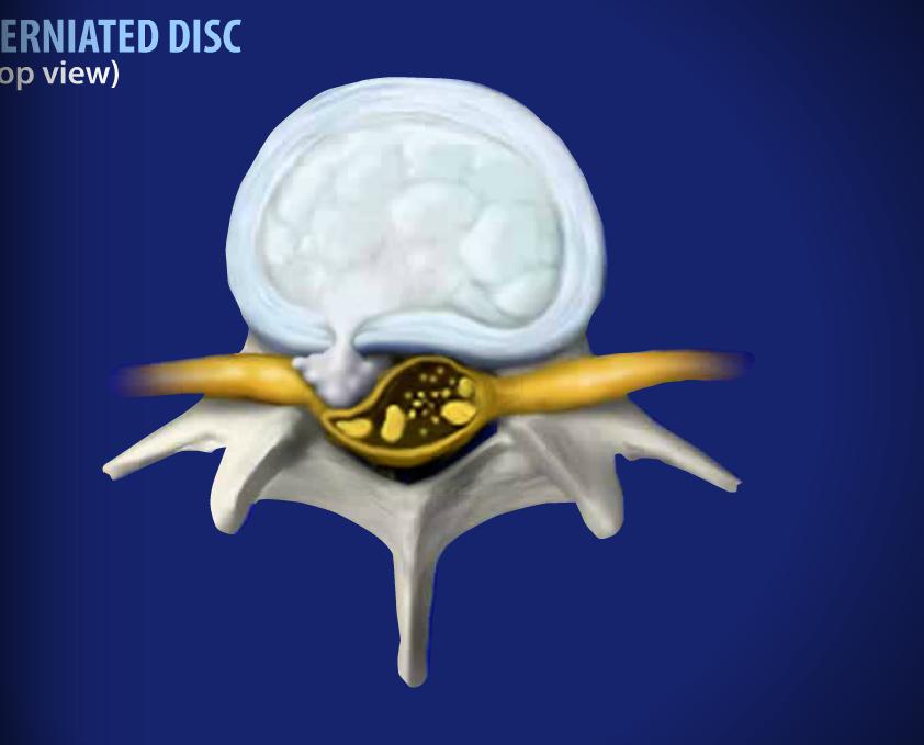 Herniated Disc Image