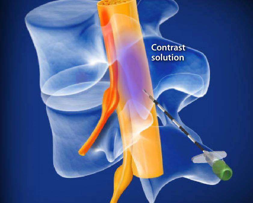 Lumbar Epidural Steroid Injection Image