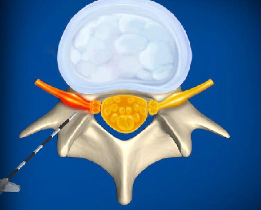 Lumbar Transforaminal Epidural Steroid Injection Image