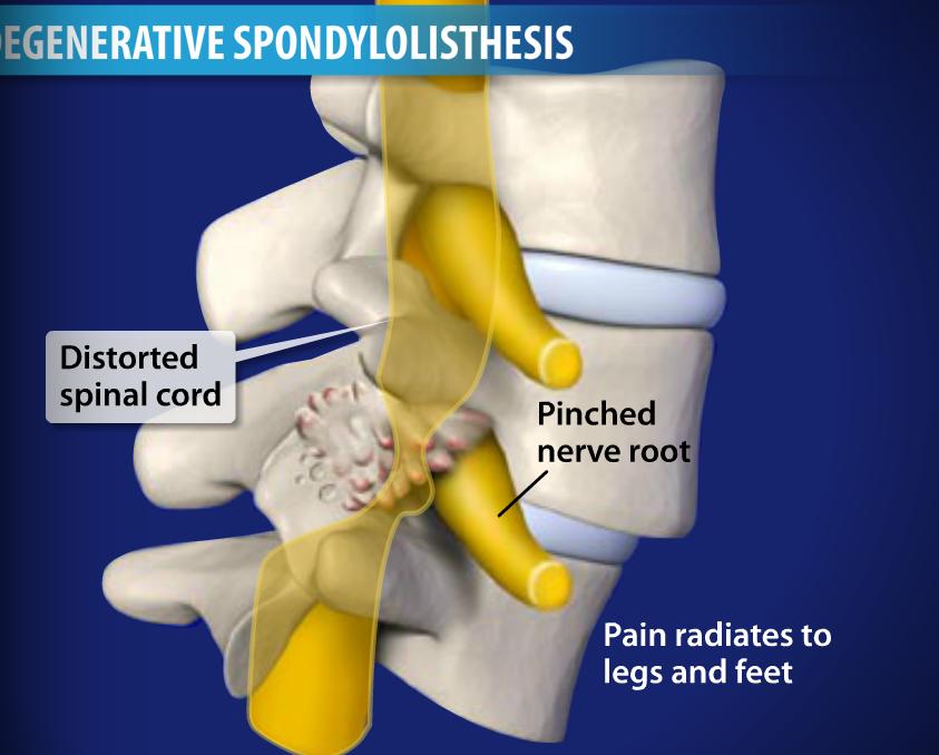 Pinched Nerves Image