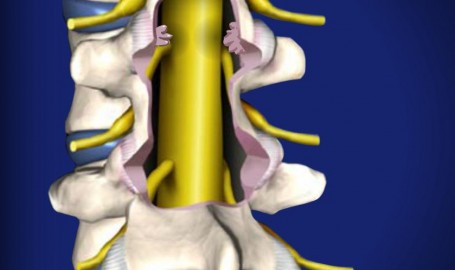 postlaminectomysyndrome