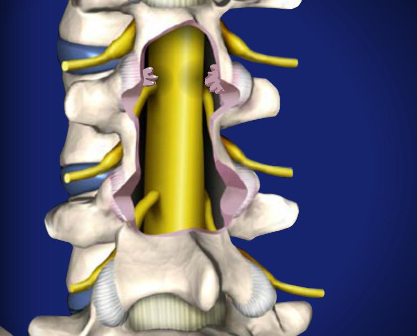 Post Laminectomy Syndrome Image