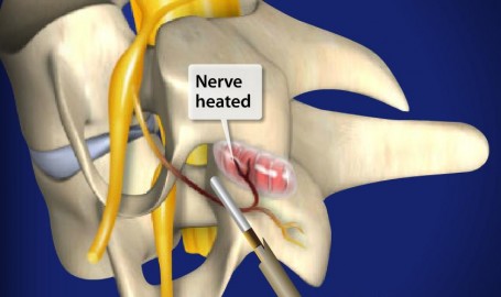 radiofrequencyneurotomycervicalfacets