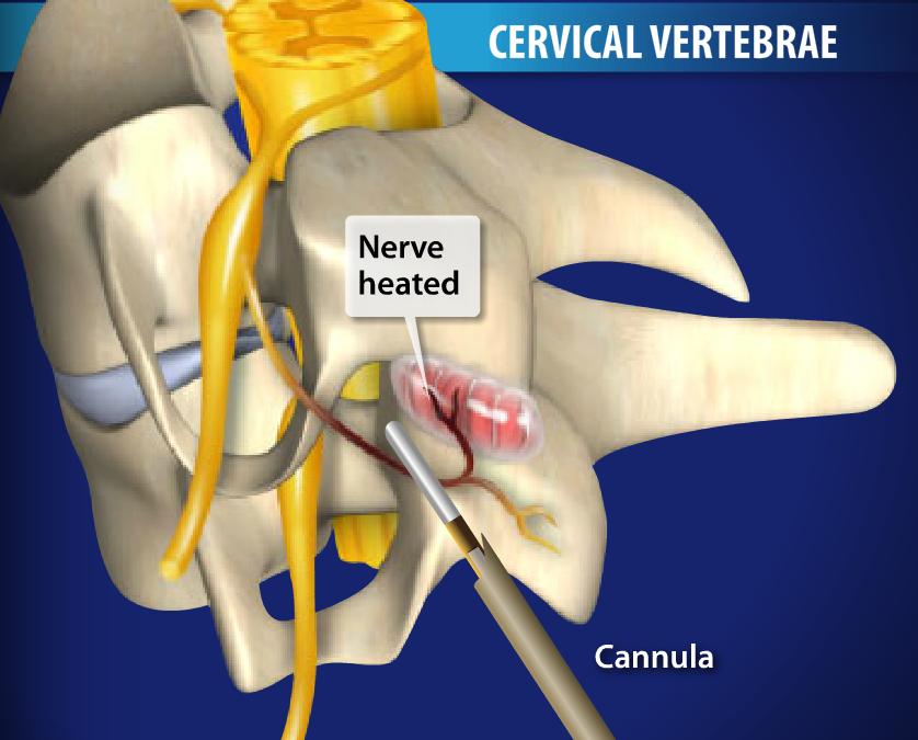 Radiofrequency Neurotomy of the Cervical Facets Image