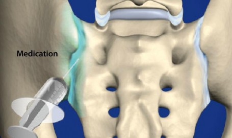 sacroiliacjointsteroidinjection