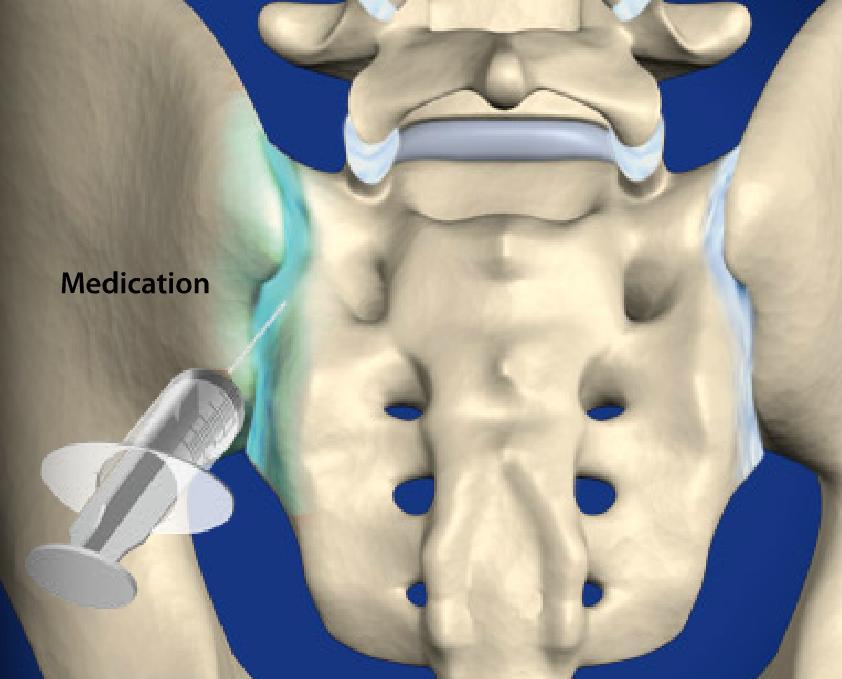 Sacroiliac Joint Steroid Injection Image