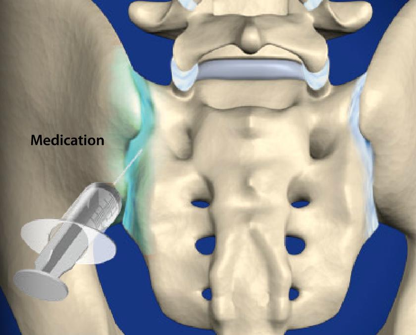 Sacroiliac Pain Image