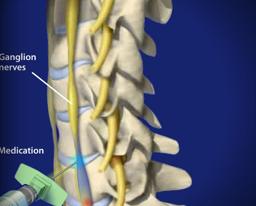 Shingles Image