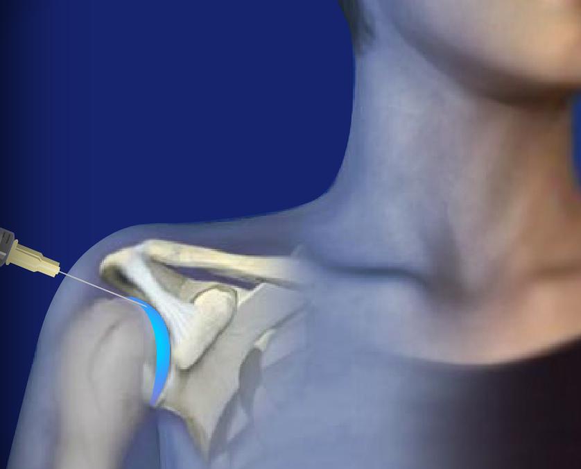 Shoulder Pain Image