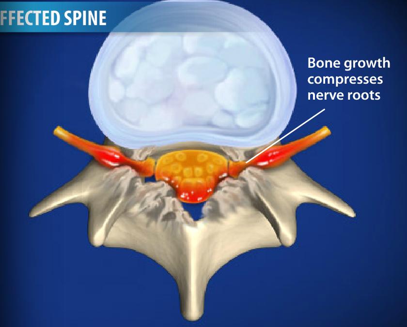 Spinal Stenosis Image