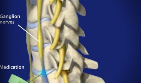 stellateganglionblock