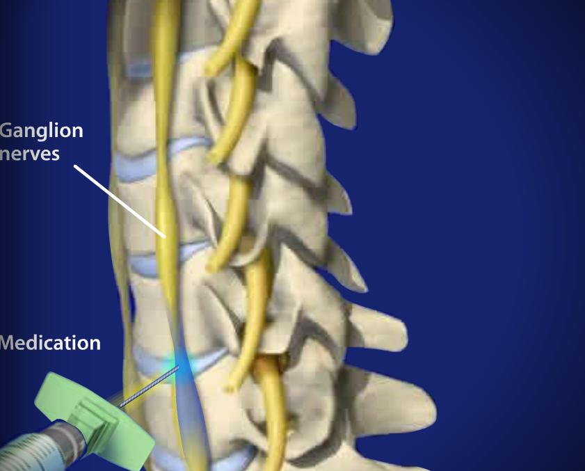 Stellate Ganglion Block Image